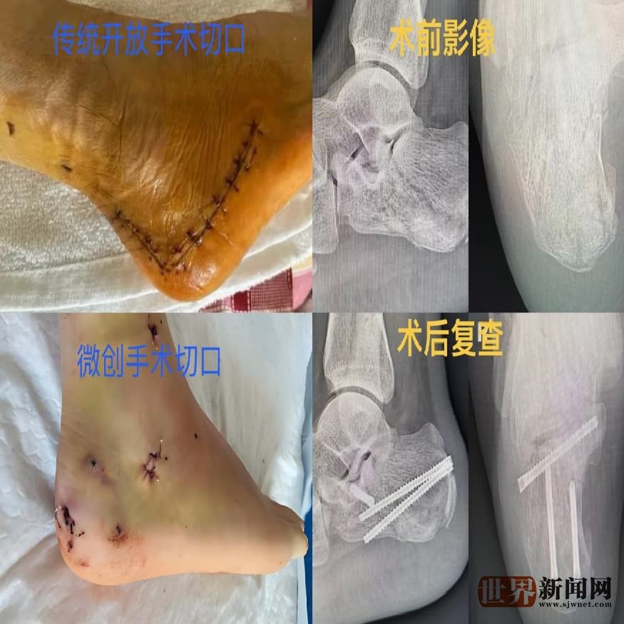足踝微创手术的匠心：省医帮扶专家袁心伟的“针尖芭蕾”